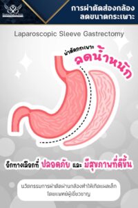 การผ่าตัดส่องกล้างลดขนาดกระเพาะ-SomchaiClinic